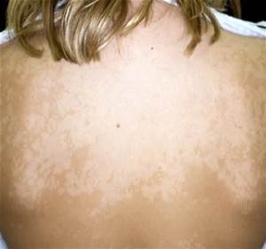 tinea versicolor skin that won’t tan white spots on skin