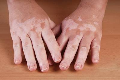 vitiligo skin that doesn't tan white spots on skin
